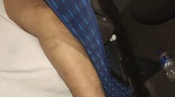 AKRABA KATİLİ OLDU